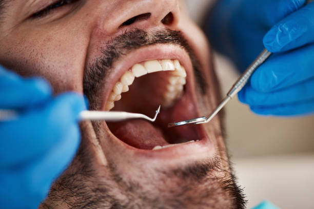Best Broken or Chipped Tooth Repair in California, PA